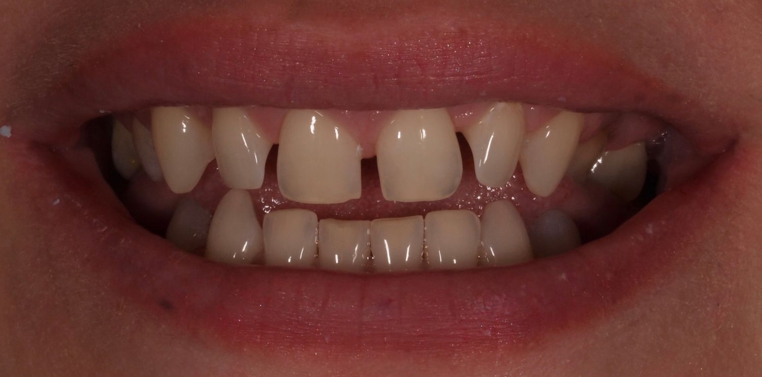 Veneers Gallery Before & After