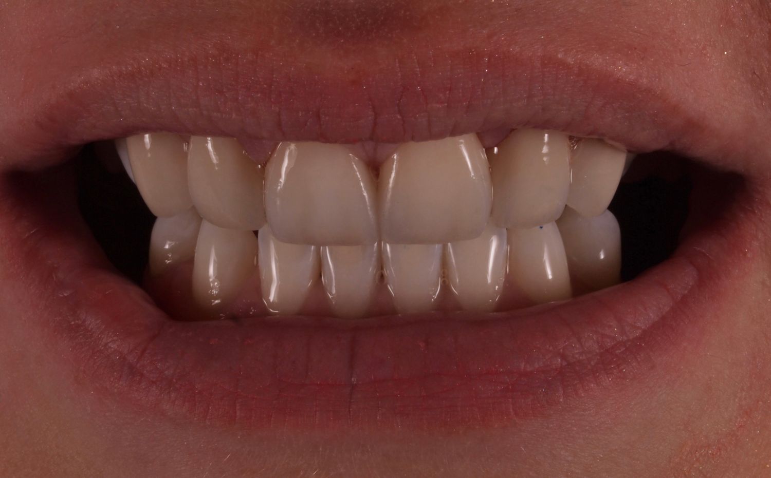Veneers Gallery Before & After