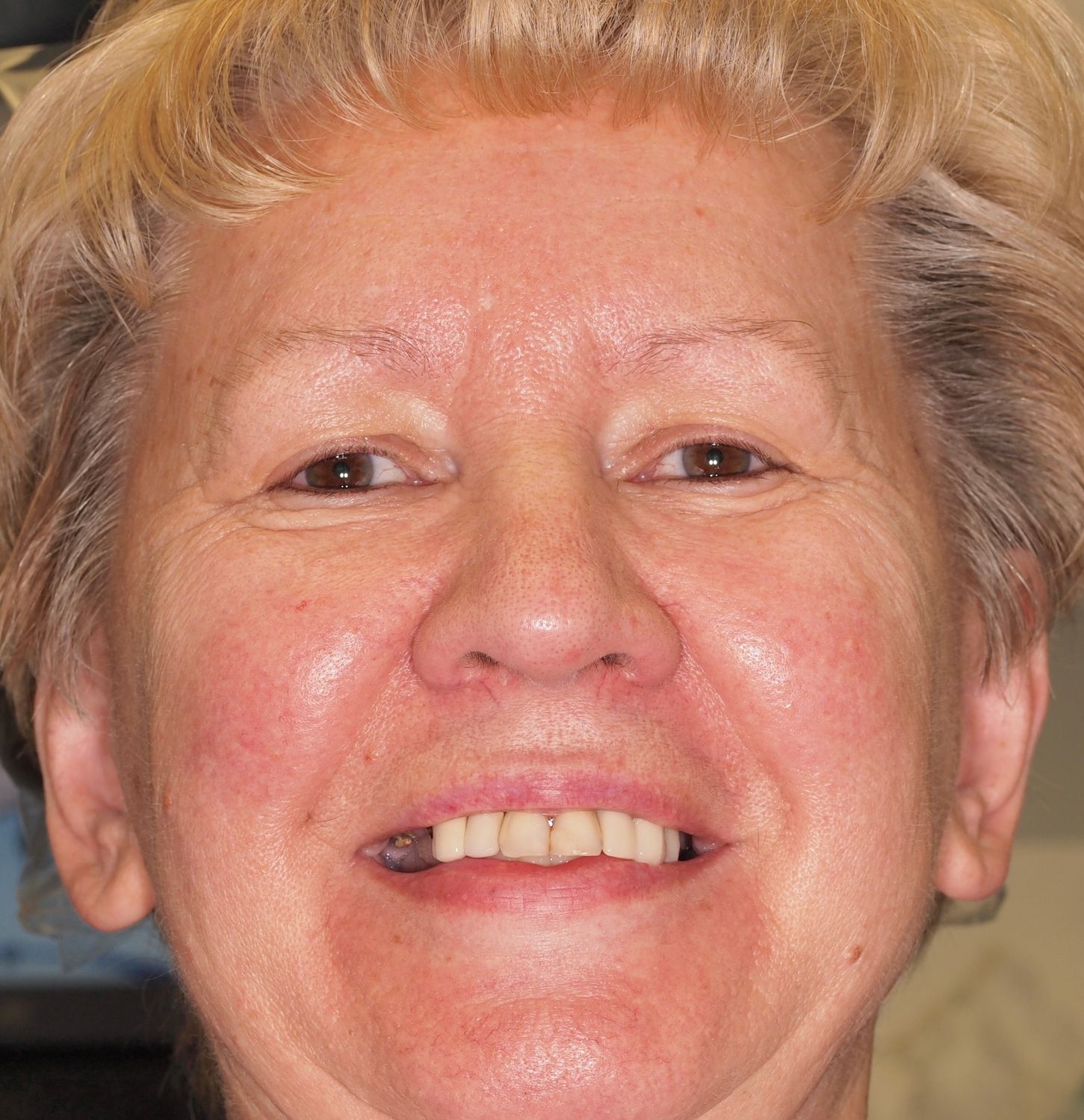 Full Mouth Veneers Before & After