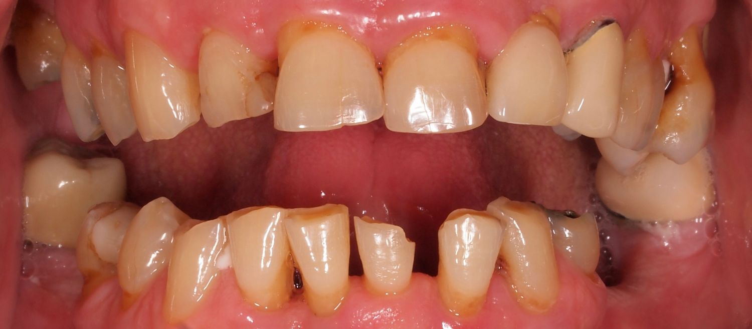 Full Mouth Veneers Before & After