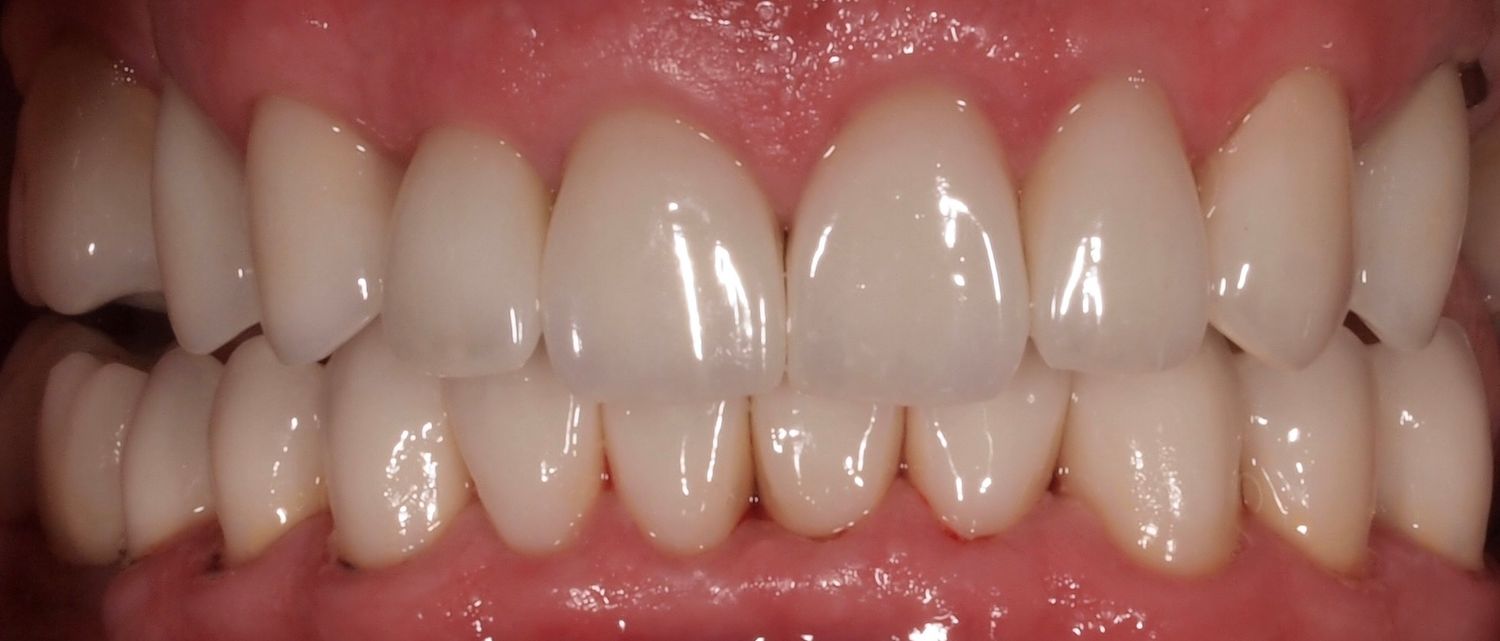 Full Mouth Veneers Before & After